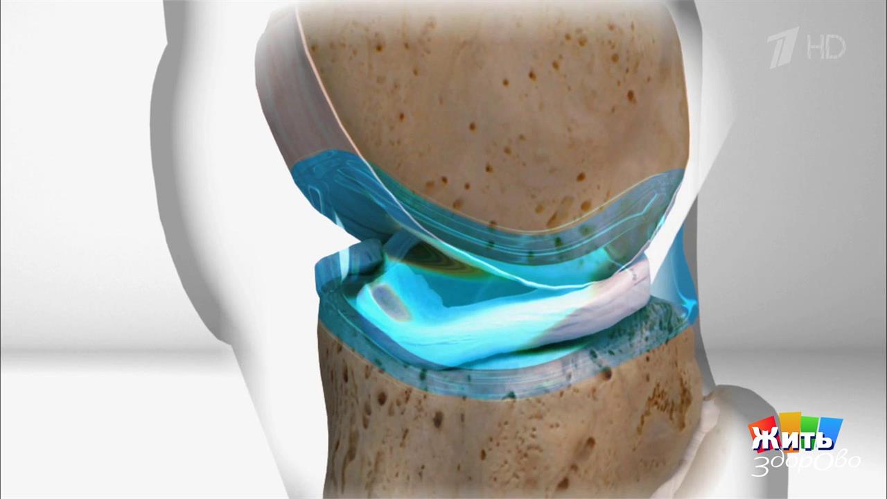 Травма мениска. Оперировать или нет? Жить здорово! Фрагмент выпуска от 03.12.2019