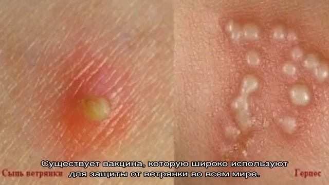 Вирус ветряной оспы и его отличия от вируса герпеса и энтеровирусной инфекции смотреть онлайн