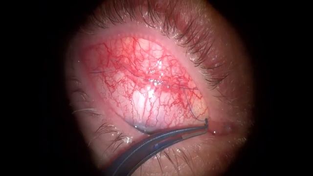 снятие шва смотреть онлайн