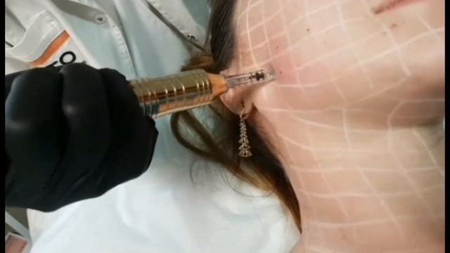 Hyaluronic pen video course. Обучающий видеокурс по гиалуроновой ручке смотреть онлайн