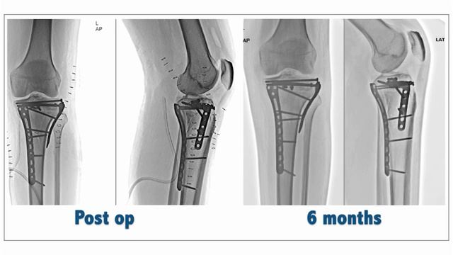 Posteromedial tibial plateau fixation смотреть онлайн