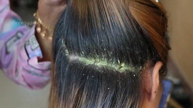 Removal Dandruff Flakes With Lice Comb Psoriasis Flakes Scalp # 1550 смотреть онлайн