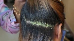 Removal Dandruff Flakes With Lice Comb  Psoriasis Flakes Scalp # 1550