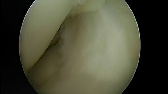 Ушивание мениска