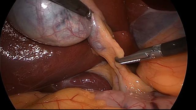 Видалення дермоїдної кісти смотреть онлайн