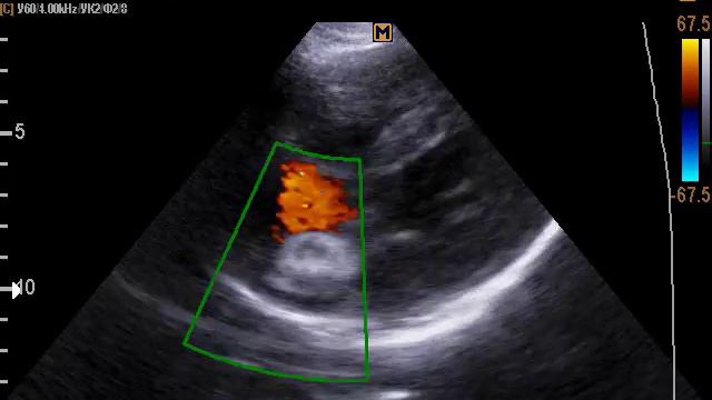 Межпредсердный окклюдер (9-5-17) смотреть онлайн