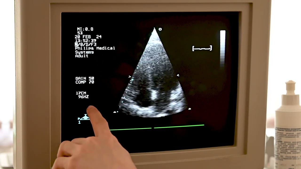 Эхокардиография. Занятие 7. Допплерография - практика на ультразвуковом аппарате смотреть онлайн