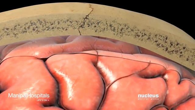 Восстановление после Геморрагического инсульта смотреть онлайн