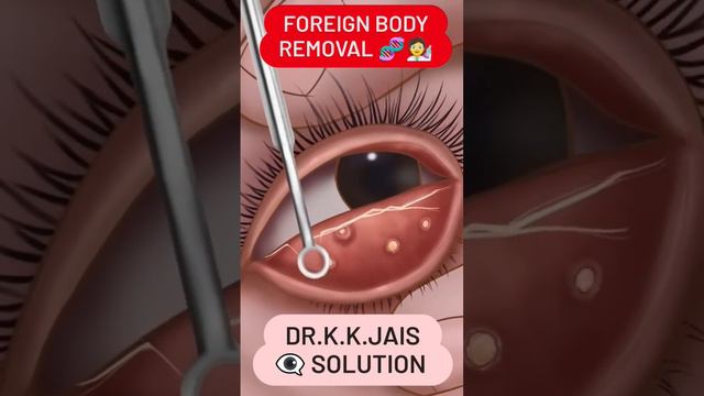 ASMR EYELID EXTRUSION (FB REMOVAL) 🧬🧑🔬🧬🧑🔬#foreignbody #extrusion @drkamalkumarjaiswal1908 смотреть онлайн