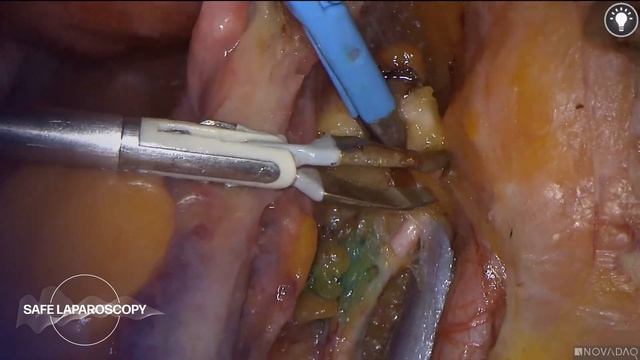 Total Laparoscopic Hysterectomy with Resection of Sentinel Lymph Nodes | Safe Laparoscopy смотреть онлайн