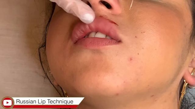 Russian Lip Technique 2021 - Lip Lifting Up - Lip Filler смотреть онлайн
