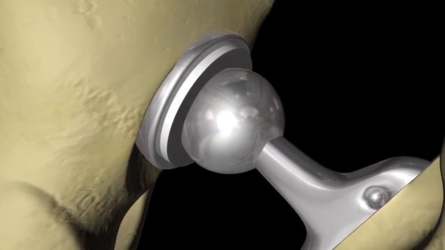 ПЕРЕЛОМ ШЕЙКИ БЕДРА смотреть онлайн