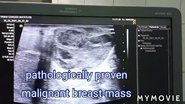 metastatic axillary lymph node due to ipsilateral breast cancer смотреть онлайн