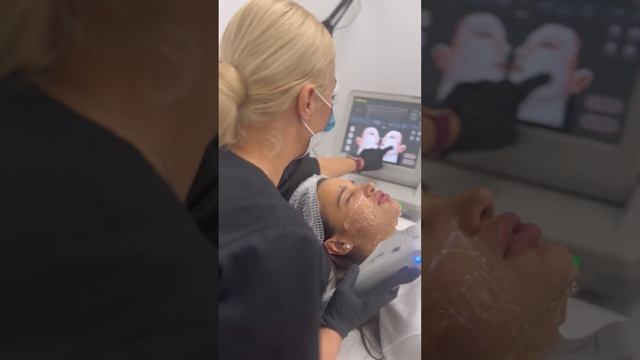 Ультразвуковой Смас-лифтинг нижней трети лица #смаслифтинг смотреть онлайн