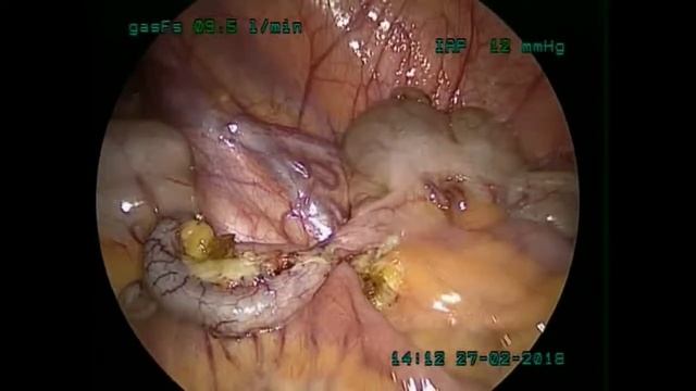 Laparoscopic Appendesectomy and Lymph node Biopsy By Dr. Rajeev Doshi ID. 301816188 смотреть онлайн