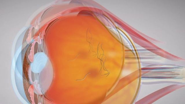 Eye Floaters: What Are They & What Causes Them? смотреть онлайн