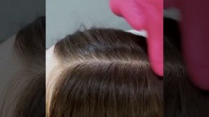 мезотерапия волосистой части кожи головы