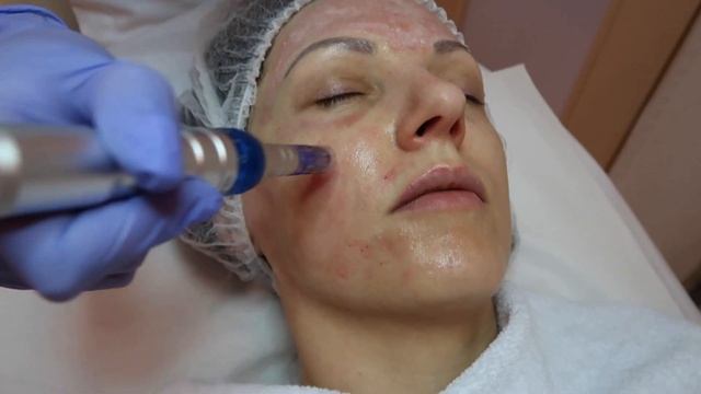 Дермапен (DERMAPEN) как выглядит процедура?