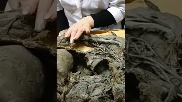 Brachial plexus смотреть онлайн