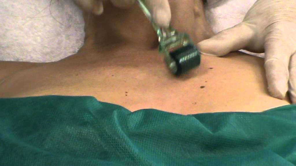 Микронидлинг, семинар, демо зоны декольте 111207