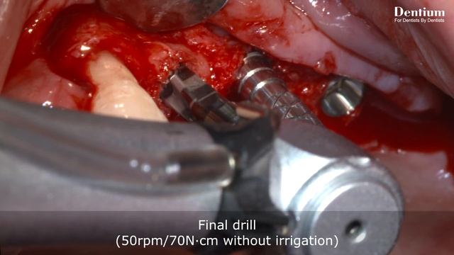 Sinus elevation – Lateral approach using New Dentium Sinus Kit смотреть онлайн
