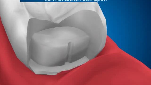 Ортопедическая стоматология. Восстановление коронковой части зуба керамической вкладкой. смотреть онлайн