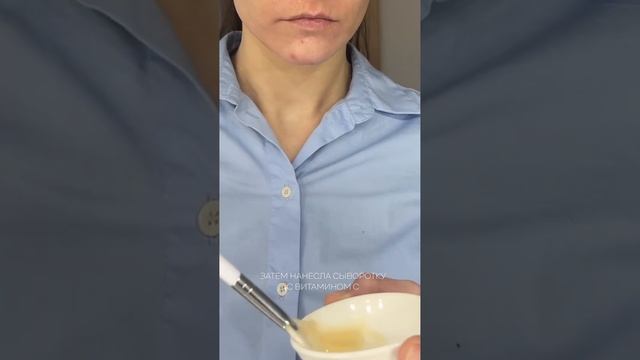 Что творит пилинг Джеснера в моем исполнении ?? #акне #кожа #пилинг #косметология #екатеринбург смотреть онлайн