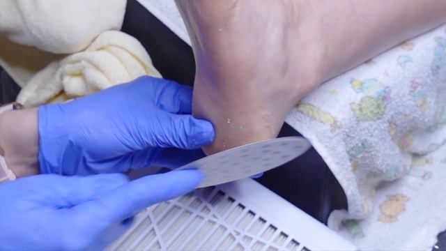 Pedicure Transformation - Callus Removal On Feet