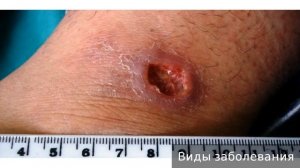 Кожный лейшманиоз  Как лечить кожный лейшманиоз