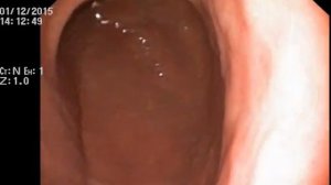 Гастроскопия с биопсией