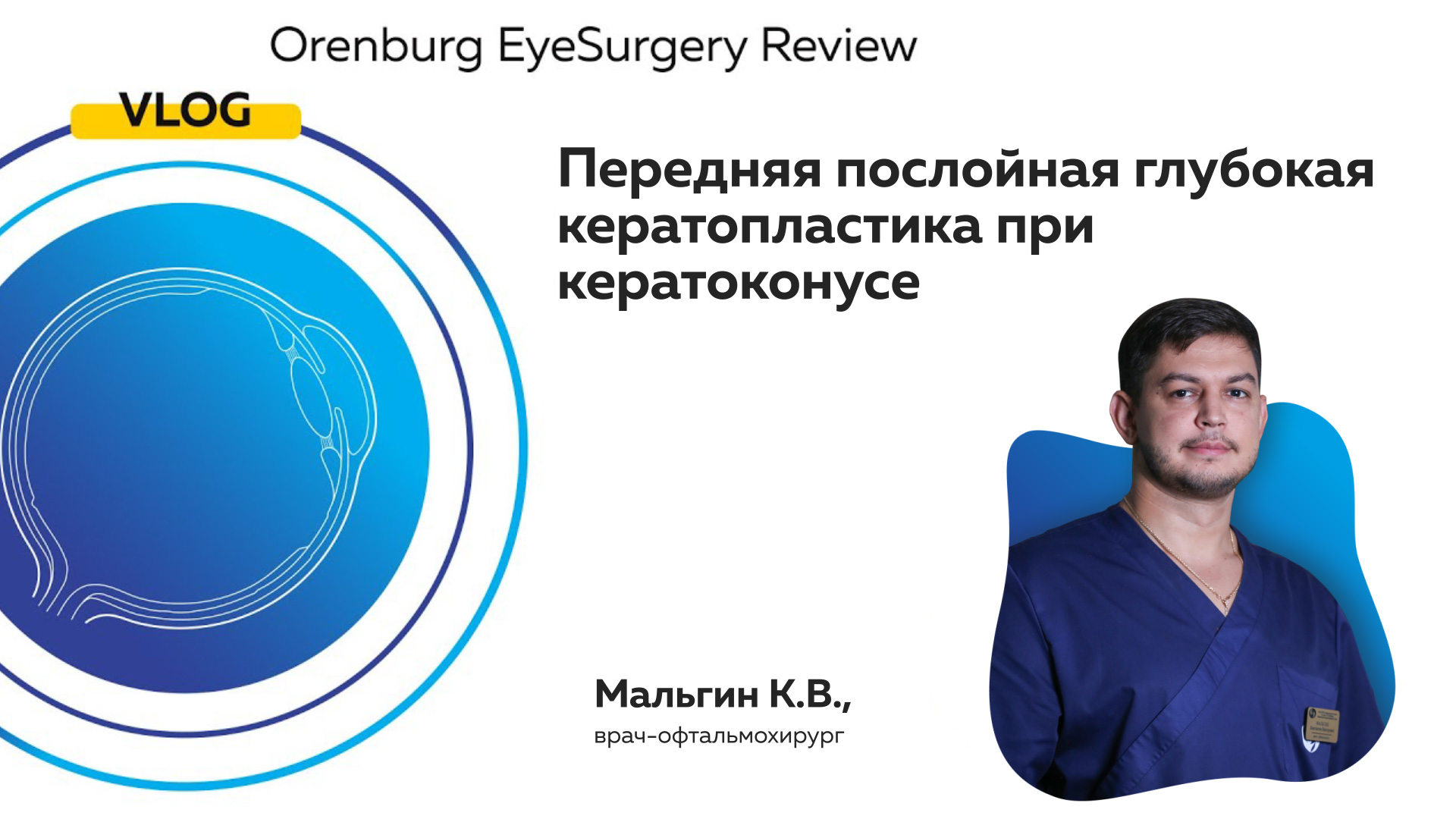 Передняя послойная глубокая кератопластика при кератоконусе