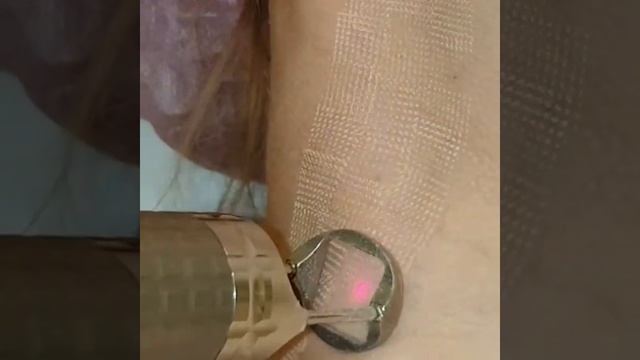 Лазерное омоложение шеи.fotona смотреть онлайн