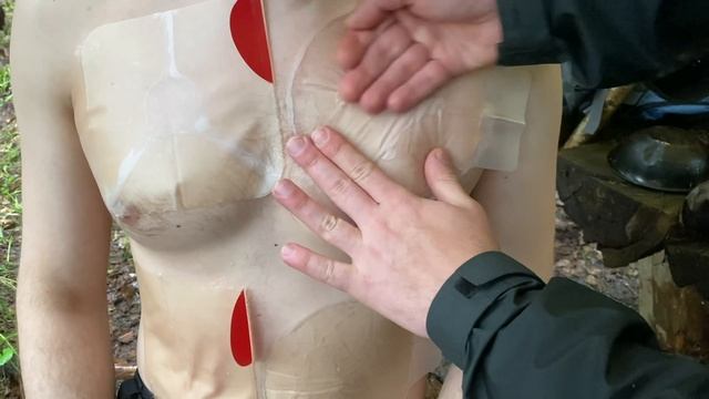 Окклюзионные пластыри. Оригиналы против Китая. смотреть онлайн