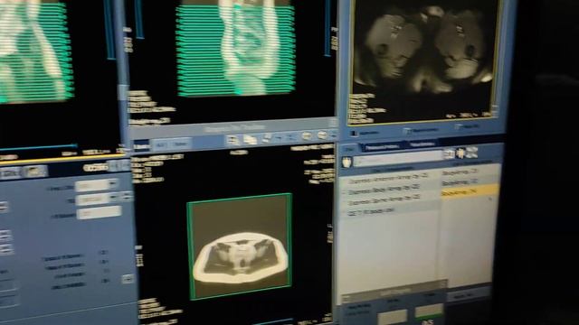 Abdomen and Pelvis MRI scan protocol, positioning and planning on GE 1.5 Tesla. смотреть онлайн