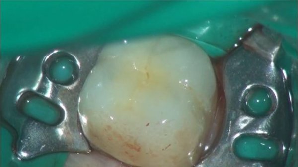 сломанный винт абатмента