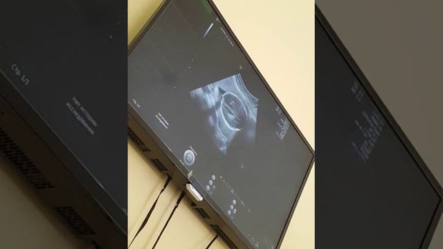 узи подробное Надюшки 20недель смотреть онлайн