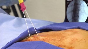 РЧА радиочастотная абляция в лечении межпозвонковых грыж и хронической боли в спине