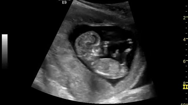 УЗИ плода в клинике "Энерго" (Санкт-Петербург) смотреть онлайн