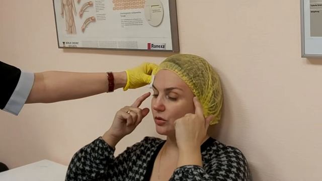 Подтяжка бровей и верхнего века нитями Коги. смотреть онлайн