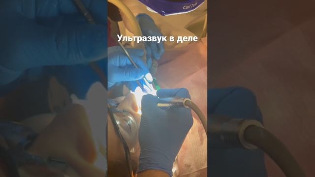 Ультразвуковое извлечение штифта из зуба смотреть онлайн