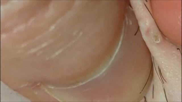 Удаление вросших волос. смотреть онлайн