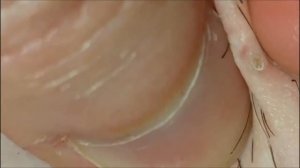 Удаление вросших волос.