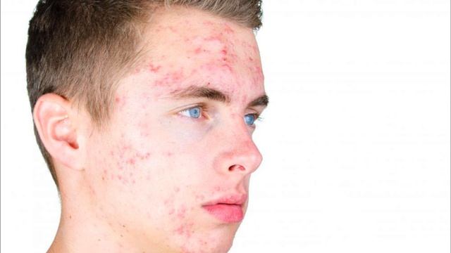 Как избавиться от следов от прыщей? смотреть онлайн