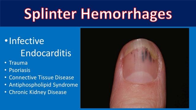 Fingernails in Heart Disease смотреть онлайн