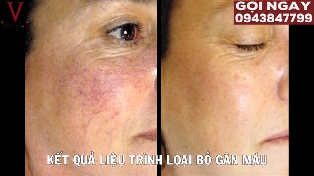 Trị giãn mao mạch tại nhà || điều trị giãn mao mạch ở mặt || giãn mao mạch ở mặt смотреть онлайн