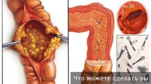 Колит. Как лечить колит.