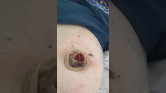 Как правильно клеить калоприемник. Уход за колостомой. Часть 2.