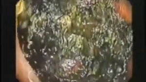 Кишечник изнутри.  Здоровье и продолжительность жизни находится в кишечнике.