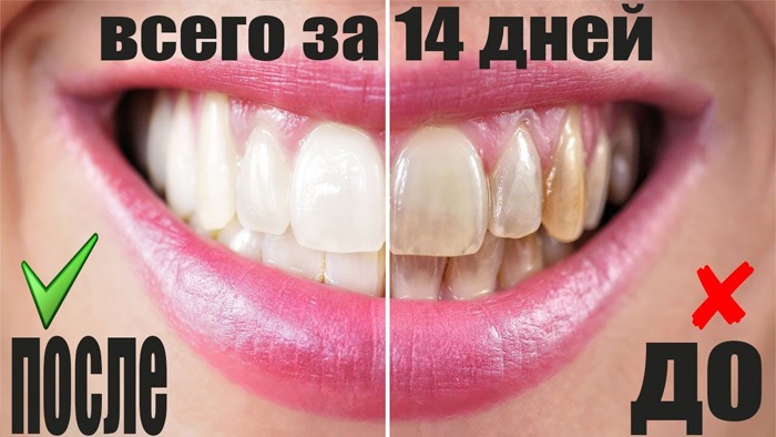 РЕАЛЬНЫЙ Способ Отбелить Зубы в Домашних Условиях\\ ТРЮКИ КАК БЫСТРО УБРАТЬ ЗУБНУЮ БОЛЬ смотреть онлайн