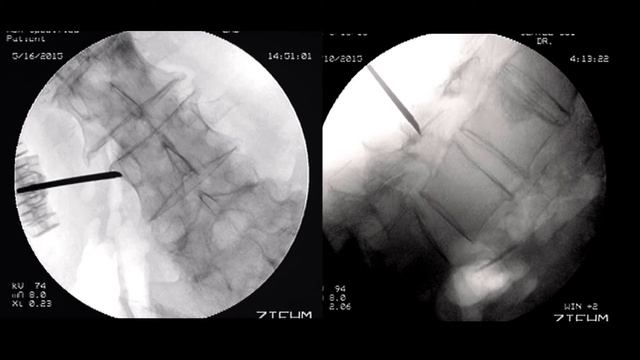 Гемангиома, патологический перелом позвонка на фоне остеопороза. что делать? вертебропластика смотреть онлайн